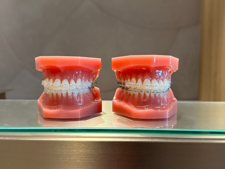 歯の表面に装着する「唇側からの矯正治療」の画像