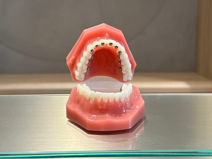 歯の裏側に装着する「舌側矯正治療」の画像