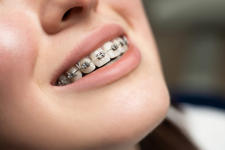歯列矯正は大人の女性に大人気！人気の理由や知っておくべき情報を大公開！の画像