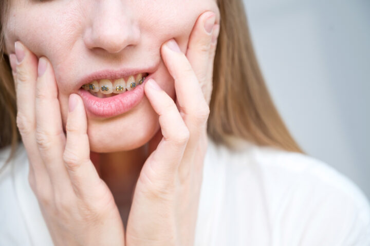 歯列矯正はやっぱり痛い？どんなときに痛い？痛みの期間や和らげる方法を解説の画像