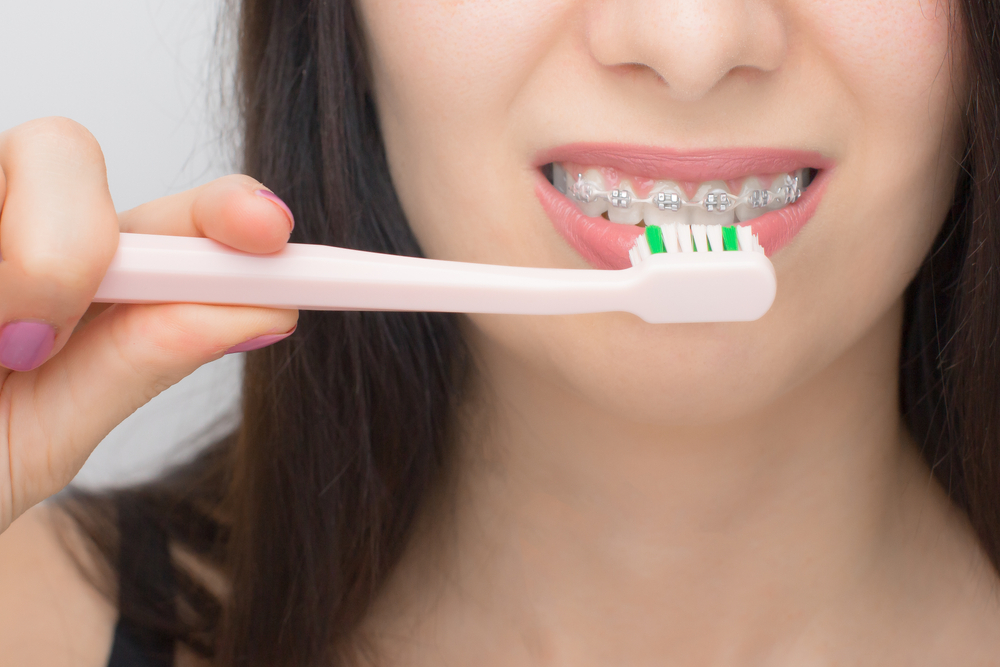 歯列矯正中の正しい歯磨き方法を紹介！歯磨きのポイントと虫歯にならないためのコツ