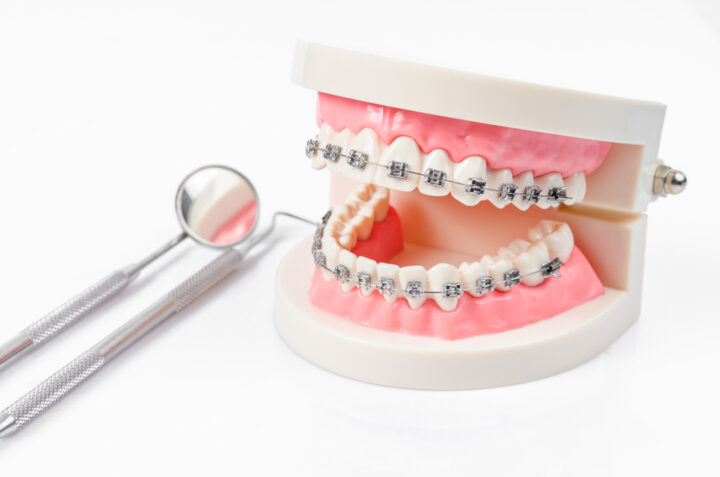 先天性疾患の矯正歯科治療の画像