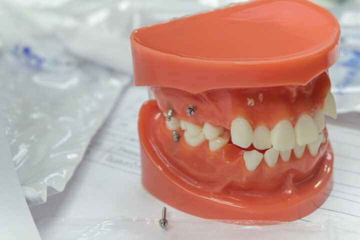 歯科矯正用アンカースクリューを用いた治療の画像