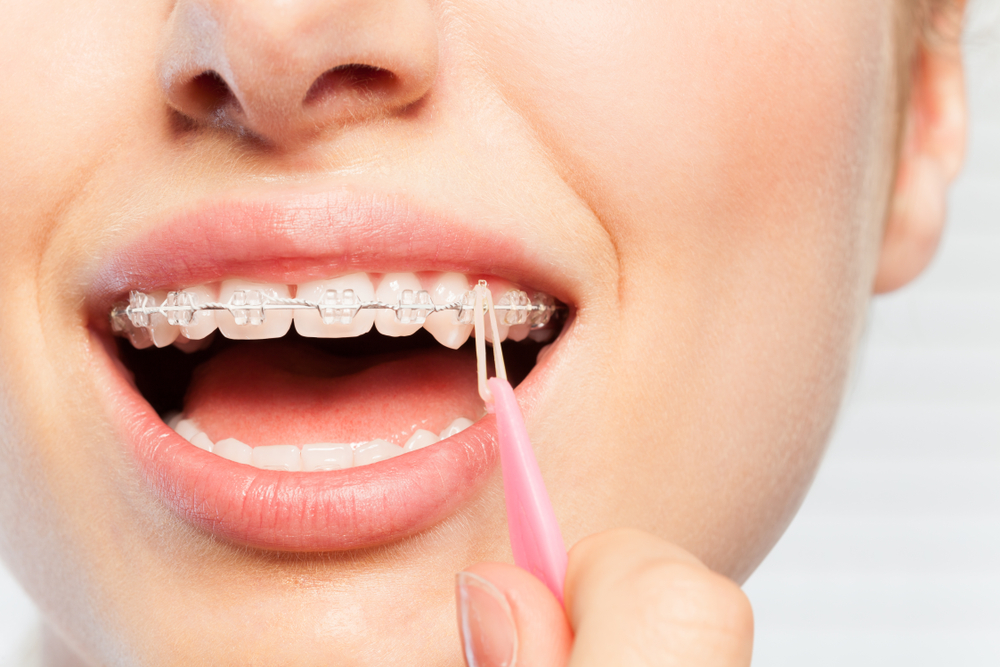 歯列矯正におけるゴムかけの効果とは？ゴムかけの種類や使用方法・期間を解説