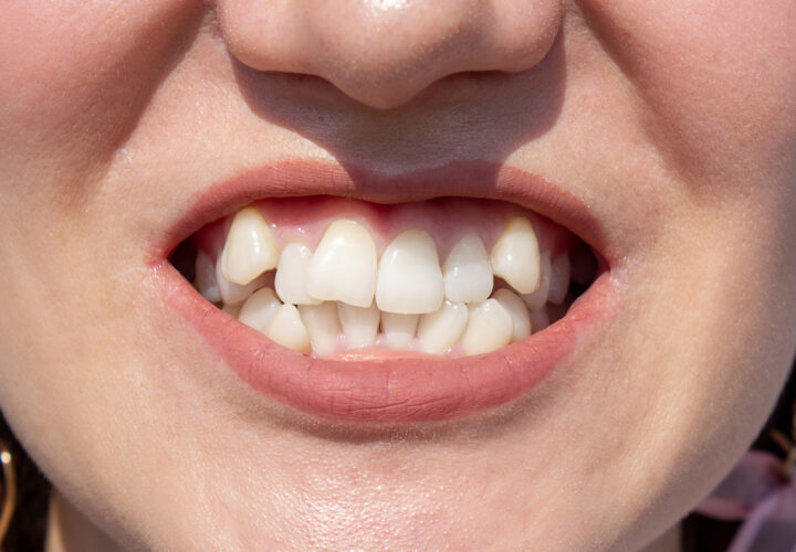 八重歯は矯正で治せる！治療の種類・方法・費用・期間を矯正歯科認定医が解説の画像