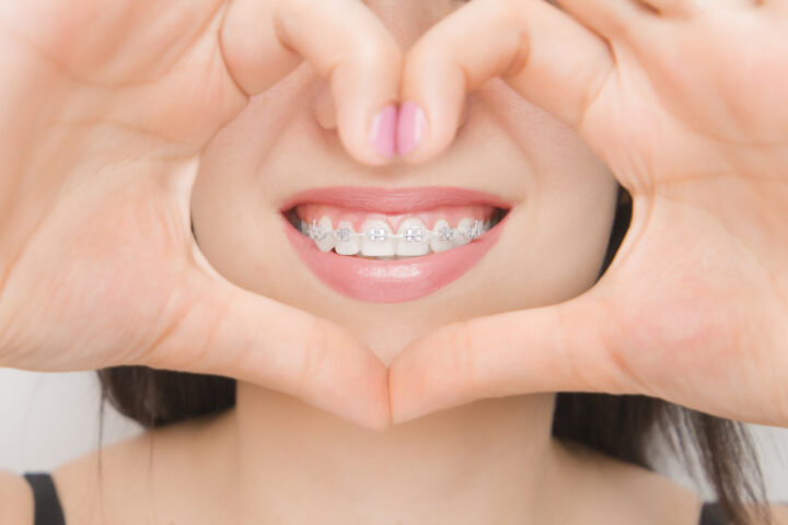 歯列矯正の装置をつけるまでの流れとは？矯正歯科の治療方法と自分で気をつけることの画像