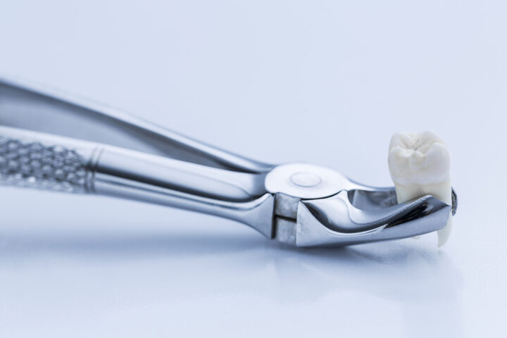 インビザラインで抜歯をするケースを紹介！抜歯ありの矯正治療の注意点とは？の画像